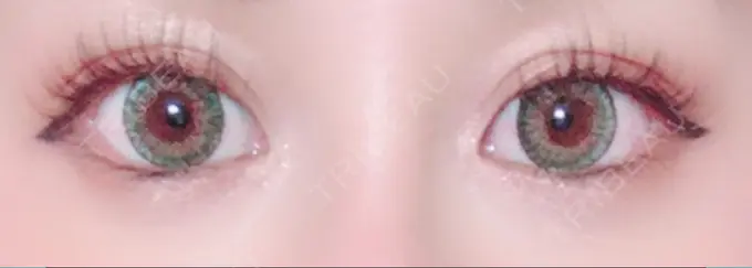 タレ目形成・グラマラスライン（切開） / その他（目元） グローバルビューティークリニック 大阪院 AFTER メイン用