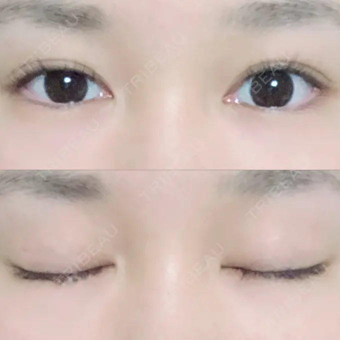 二重切開 / 上まぶたの脂肪取り / その他（目元） 湘南美容クリニック 新宿本院 AFTER メイン用