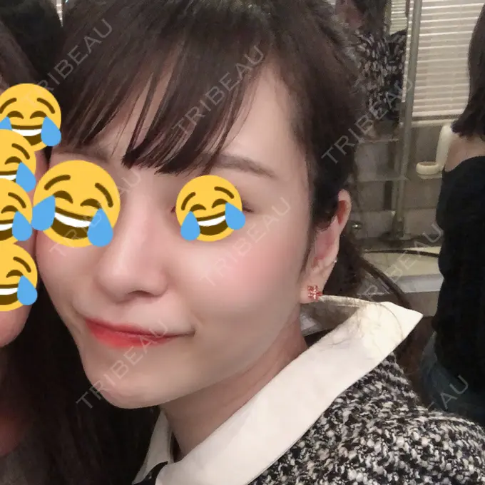 鼻尖形成（切開） / 小鼻縮小（切開） / 軟骨移植 / 骨切幅寄せ / ワシ鼻修正・ハンプ切除 FROM B整形外科 (旧バウム整形外科) AFTER メイン用