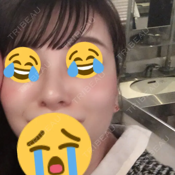 鼻尖形成（切開） / 小鼻縮小（切開） / 軟骨移植 / 骨切幅寄せ / ワシ鼻修正・ハンプ切除 FROM B整形外科 (旧バウム整形外科) DAY 139 メイン用