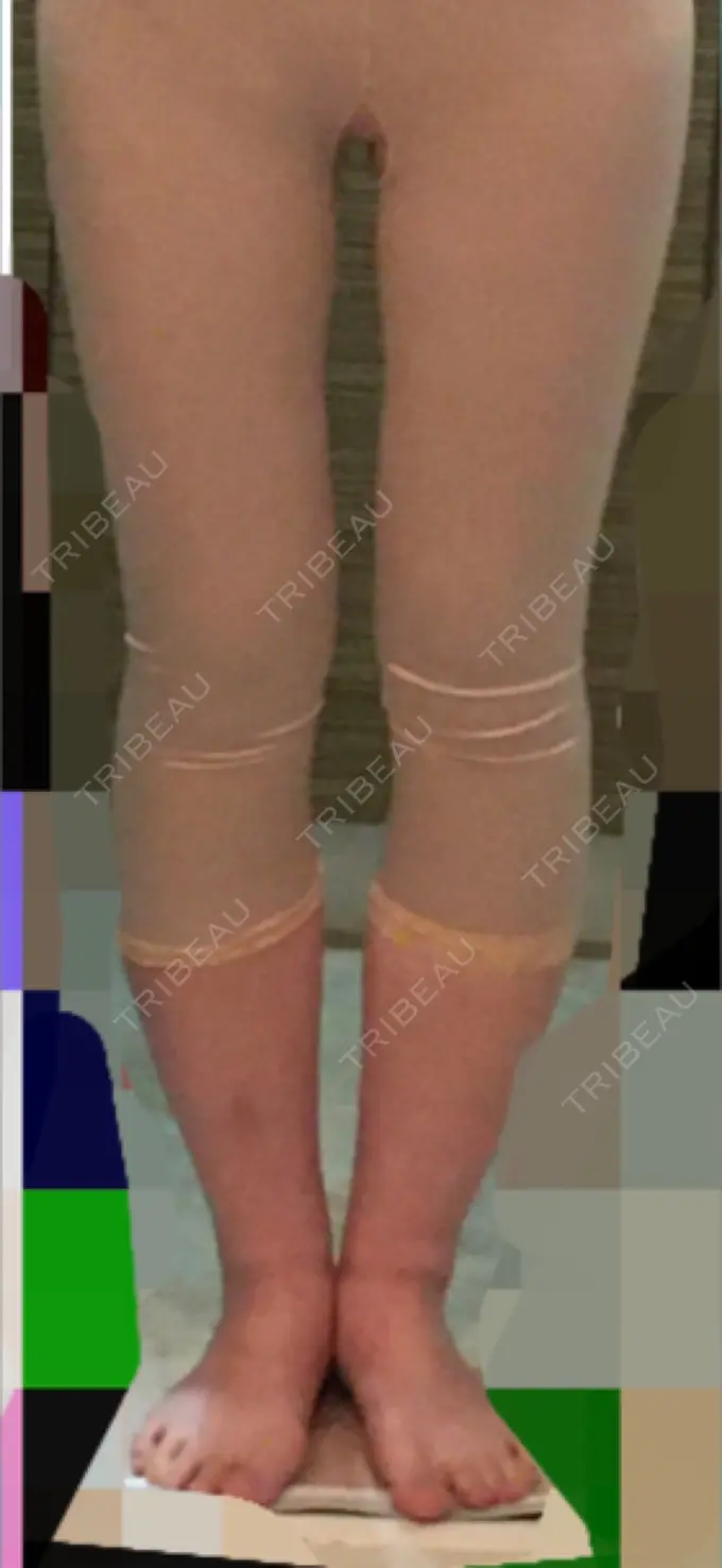 脂肪吸引（脚） / 脂肪吸引（お尻） ドクターフィット（Dr.fit）クリニック DAY 31 メイン用