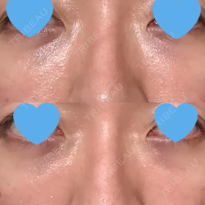 クマ治療 / 下まぶたたるみ取り / 下まぶたの脂肪取り 湘南美容クリニック 大阪あべの院 DAY 20 メイン用