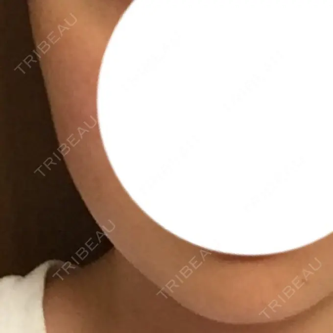 ボトックス（エラ・小顔） 湘南美容クリニック 仙台院 AFTER メイン用