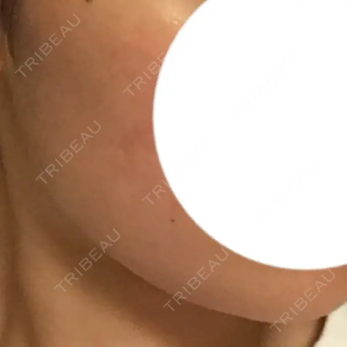 ボトックス（エラ・小顔） 湘南美容クリニック 仙台院 DAY 10 メイン用