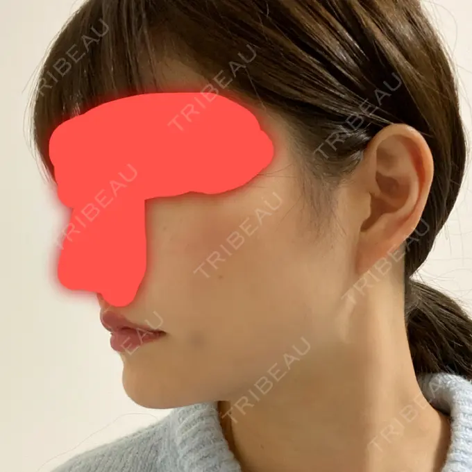 脂肪吸引（顔） / ボトックス（エラ・小顔） / 美容点滴・美容注射（美肌） エートップ美容整形外科 DAY 17 メイン用