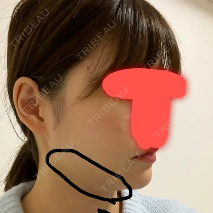 脂肪吸引（顔） / ボトックス（エラ・小顔） / 美容点滴・美容注射（美肌） エートップ美容整形外科 DAY 17 メイン用