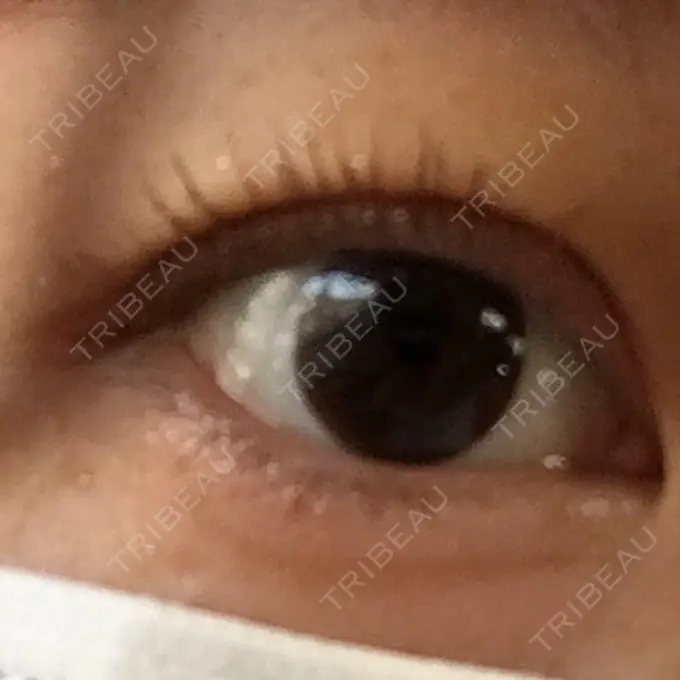 二重埋没 湘南美容クリニック 京都院 DAY 4 メイン用