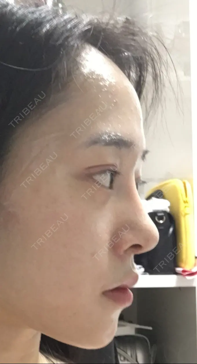 二重埋没 / 隆鼻術 / 豊胸（シリコンバッグ） MIGO（ミゴ）整形外科 DAY 14 メイン用