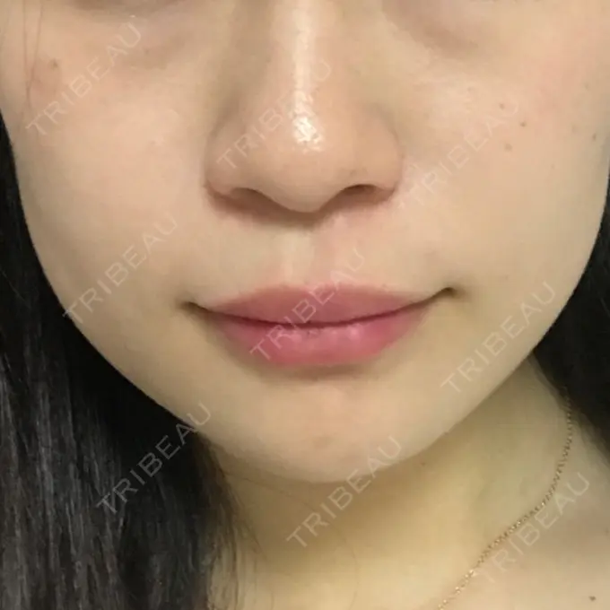 ボトックス（エラ・小顔） / 脂肪溶解注射（顔） 湘南美容クリニック 仙台院 DAY 9 メイン用