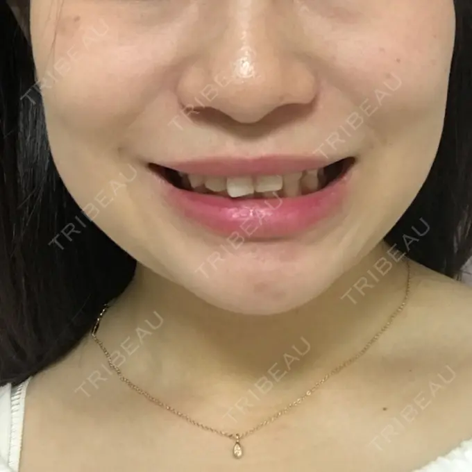 ボトックス（エラ・小顔） / 脂肪溶解注射（顔） 湘南美容クリニック 仙台院 DAY 10 メイン用