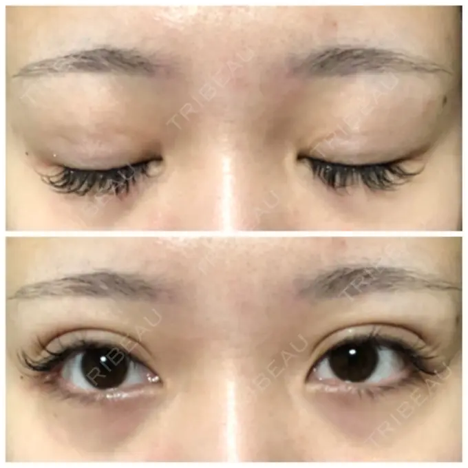 二重埋没 城本クリニック 立川院 DAY 27 メイン用