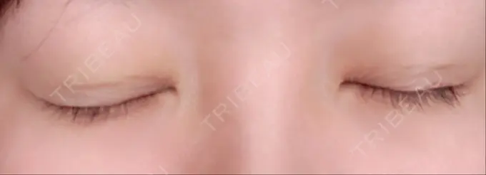 二重埋没 湘南美容クリニック 京都院 DAY 3 メイン用