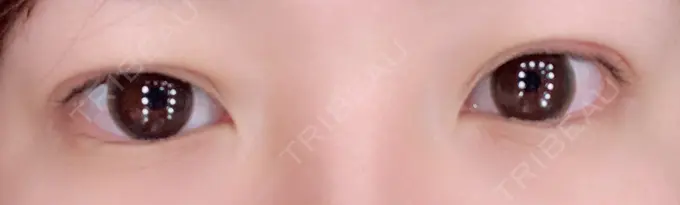 二重埋没 湘南美容クリニック 京都院 DAY 3 メイン用