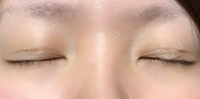 二重埋没 湘南美容クリニック 京都院 DAY 4 メイン用