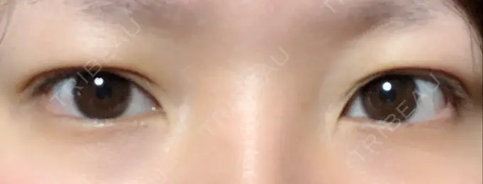 二重埋没 湘南美容クリニック 京都院 DAY 4 メイン用