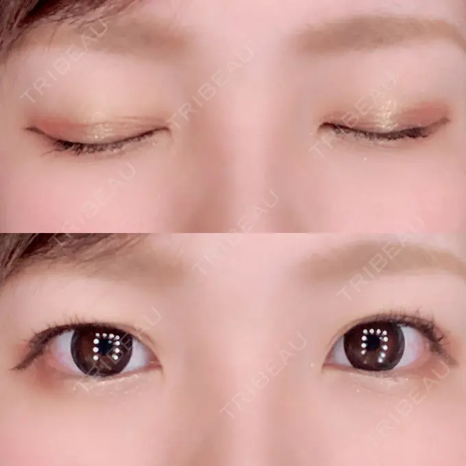 二重埋没 湘南美容クリニック 京都院 DAY 4 メイン用