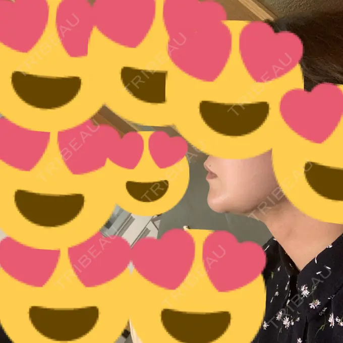 その他（目元） THE CLINIC（ザ・クリニック） 福岡院 DAY 177 メイン用