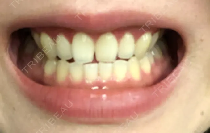 その他（審美歯科/矯正歯科） 南青山矯正歯科 DAY 16 メイン用