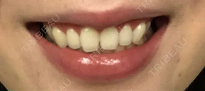 その他（審美歯科/矯正歯科） 南青山矯正歯科 DAY 37 メイン用