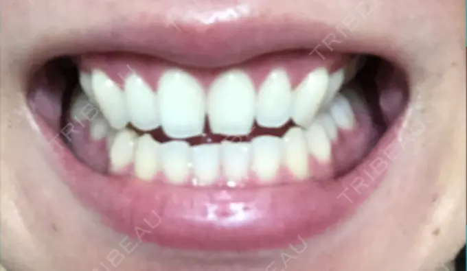 その他（審美歯科/矯正歯科） 南青山矯正歯科 DAY 46 メイン用