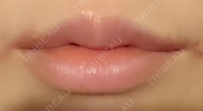 口角挙上 / その他（口元） 現代美学整形外科 DAY 26 メイン用