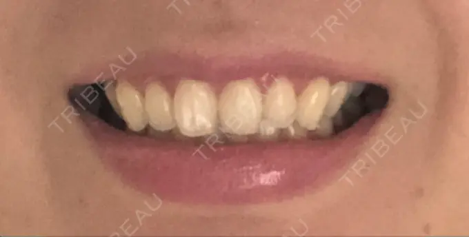 その他（審美歯科/矯正歯科） 南青山矯正歯科 DAY 50 メイン用