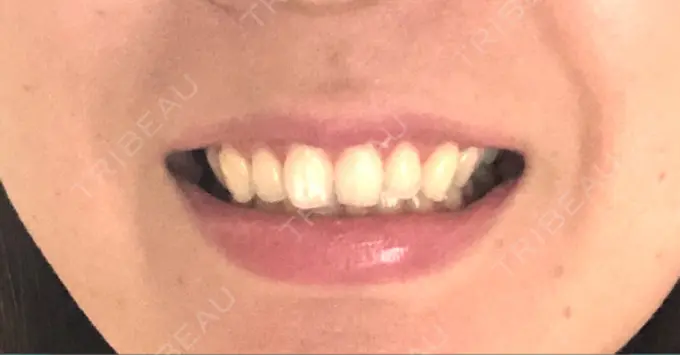 その他（審美歯科/矯正歯科） 南青山矯正歯科 DAY 49 メイン用