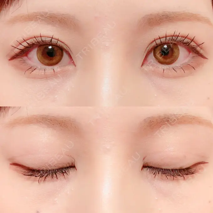 二重切開 / 上まぶたの脂肪取り / その他（目元） 銀座高須クリニック DAY 175 メイン用