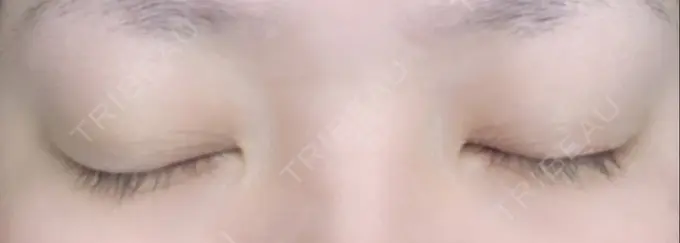 二重埋没 湘南美容クリニック 京都院 AFTER メイン用