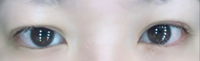 二重埋没 湘南美容クリニック 京都院 DAY 5 メイン用