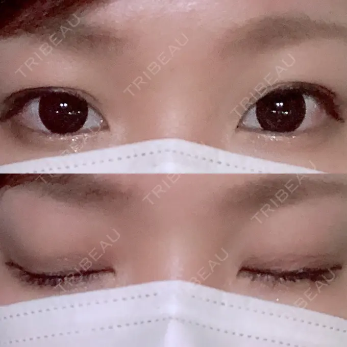 二重埋没 湘南美容クリニック 京都院 DAY 5 メイン用