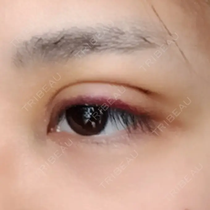 二重埋没 / 上まぶたの脂肪取り 金沢中央クリニック DAY 5 メイン用