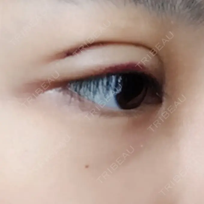 二重埋没 / 上まぶたの脂肪取り 金沢中央クリニック DAY 5 メイン用