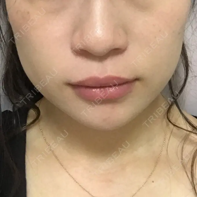 ボトックス（エラ・小顔） / 脂肪溶解注射（顔） 湘南美容クリニック 仙台院 AFTER メイン用