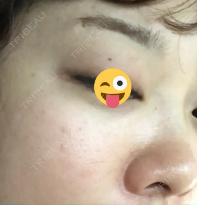 イオン導入 / 美肌レーザー / シミ取りレーザー / エレクトロポレーション 湘南美容クリニック 秋葉原院 DAY 7 メイン用