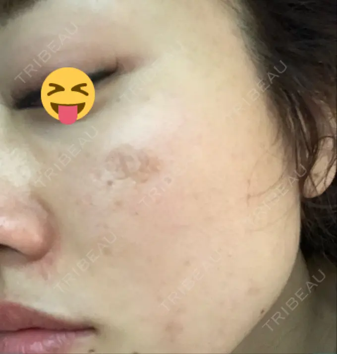 イオン導入 / 美肌レーザー / シミ取りレーザー / エレクトロポレーション 湘南美容クリニック 秋葉原院 DAY 7 メイン用