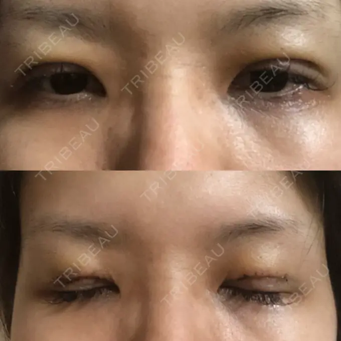 二重切開 / 目元修正 きくな湯田眼科 DAY 4 メイン用