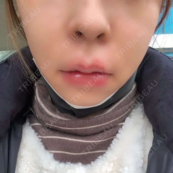 ヒアルロン酸注入（唇） / ボトックス（口角） リエンジャン整形外科 江南店 DAY 0 メイン用