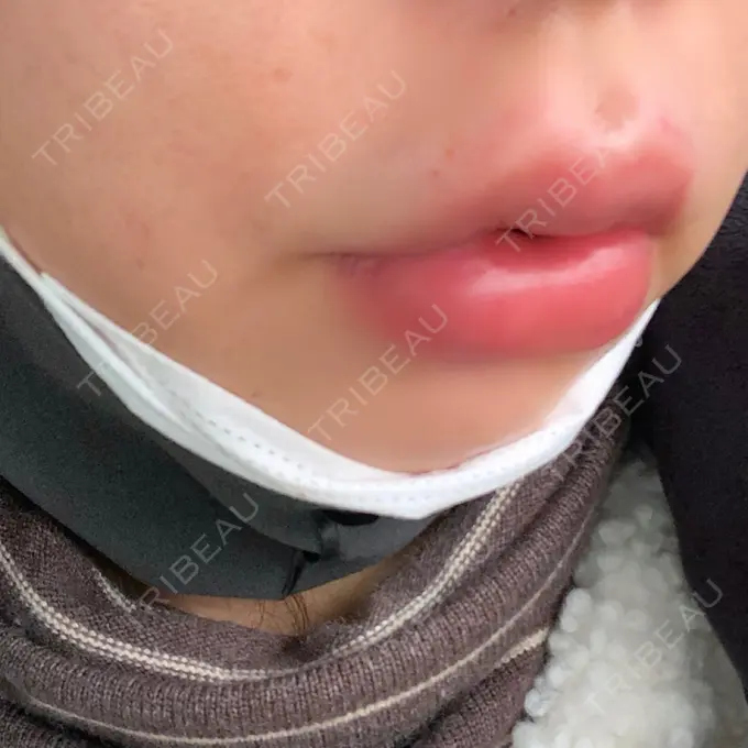 ヒアルロン酸注入（唇） / ボトックス（口角） リエンジャン整形外科 江南店 DAY 0 メイン用