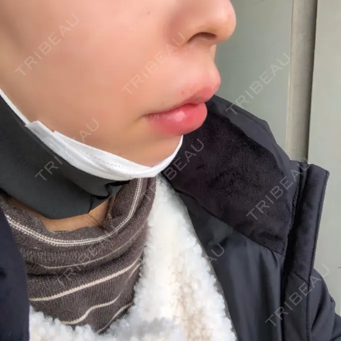 ヒアルロン酸注入（唇） / ボトックス（口角） リエンジャン整形外科 江南店 DAY 0 メイン用