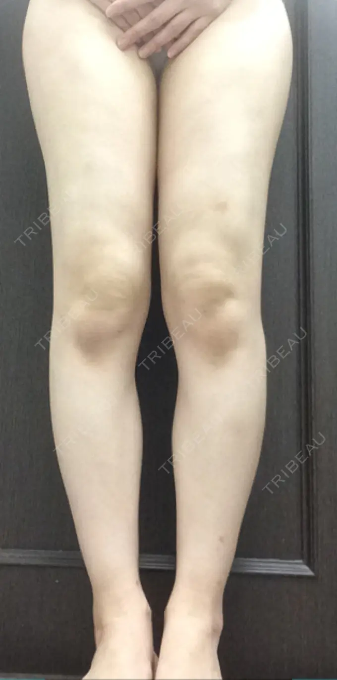 脂肪吸引（脚） / 豊胸（脂肪注入） / 胸修正 THE CLINIC（ザ・クリニック） 名古屋院 DAY 18 メイン用