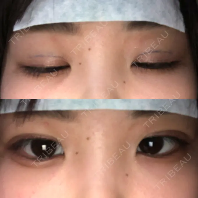 二重埋没 湘南美容クリニック 東京蒲田院 DAY 0 メイン用