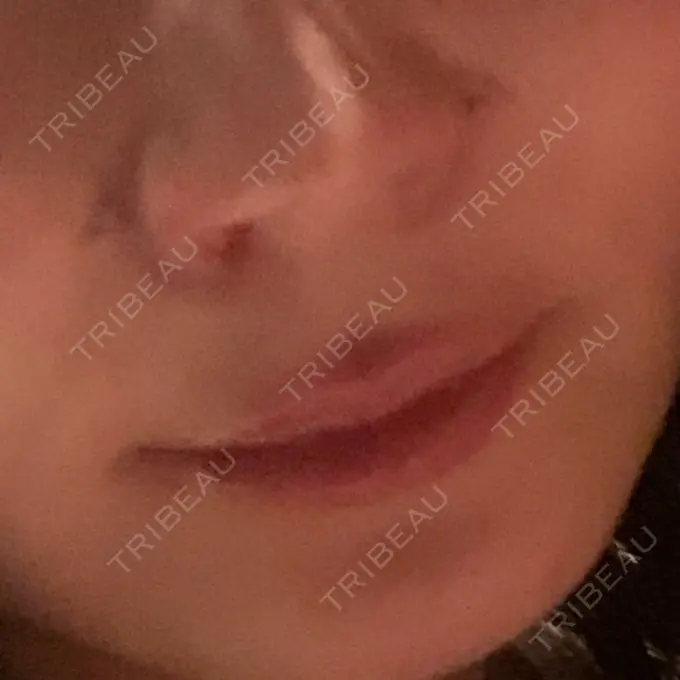 小鼻縮小（切開） / 鼻翼挙上 / 鼻孔縁挙上 大阪TAクリニック DAY 7 メイン用