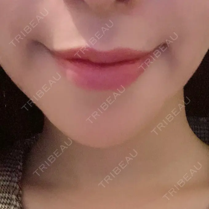 あごプロテーゼ / 骨切り（あご） / 脂肪吸引（顔） 心斎橋コムロ美容外科クリニック DAY 29 メイン用