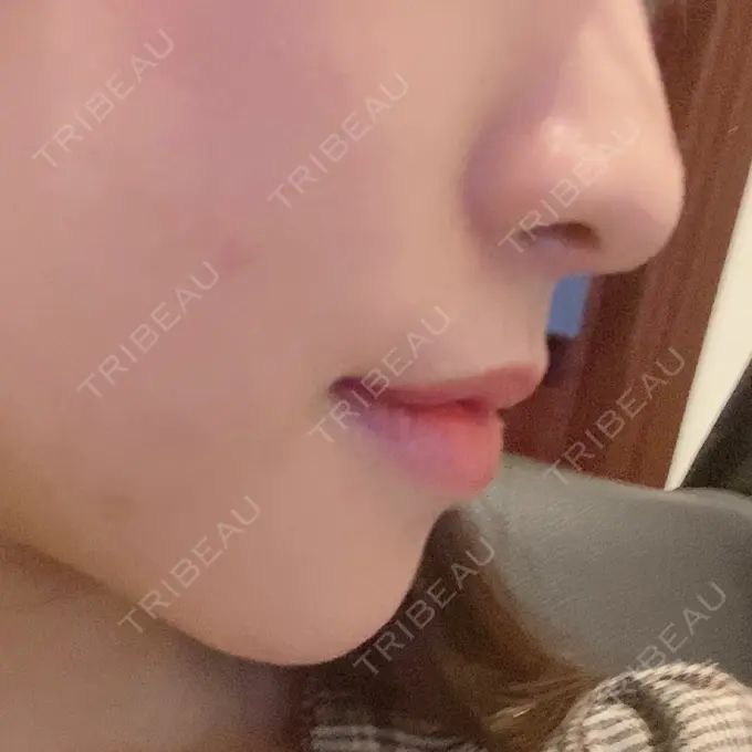 あごプロテーゼ / 骨切り（あご） / 脂肪吸引（顔） 心斎橋コムロ美容外科クリニック DAY 29 メイン用