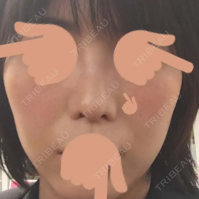 隆鼻術 / 鼻中隔延長（切開） / 斜鼻修正 / 真皮移植 / 鼻孔縁下降 加藤クリニック 麻布東京院 DAY 31 メイン用