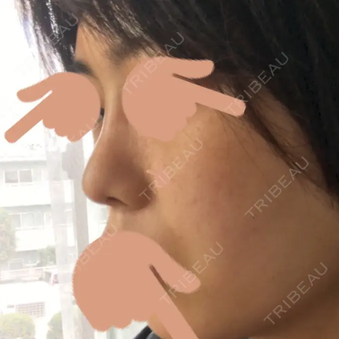 隆鼻術 / 鼻中隔延長（切開） / 斜鼻修正 / 真皮移植 / 鼻孔縁下降 加藤クリニック 麻布東京院 DAY 31 メイン用