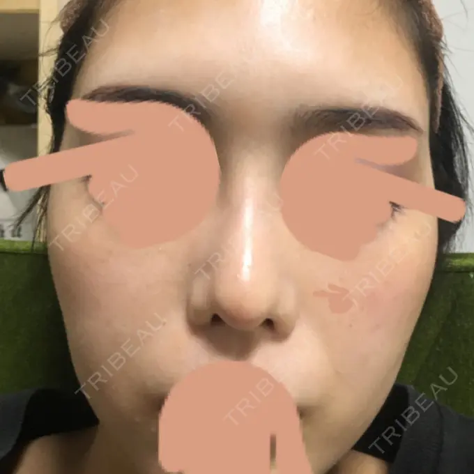 隆鼻術 / 鼻中隔延長（切開） / 斜鼻修正 / 真皮移植 / 鼻孔縁下降 加藤クリニック 麻布東京院 DAY 62 メイン用