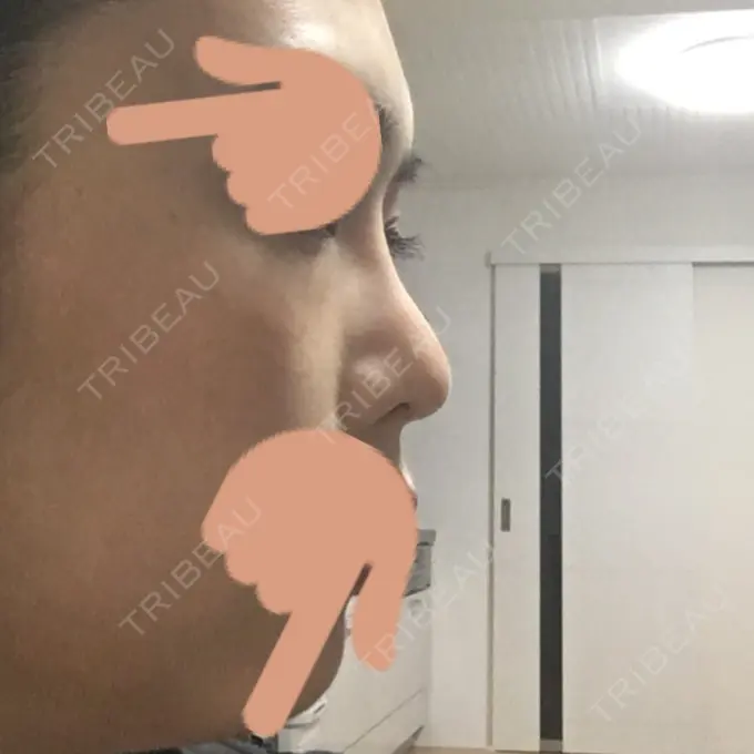 隆鼻術 / 鼻中隔延長（切開） / 斜鼻修正 / 真皮移植 / 鼻孔縁下降 加藤クリニック 麻布東京院 DAY 62 メイン用