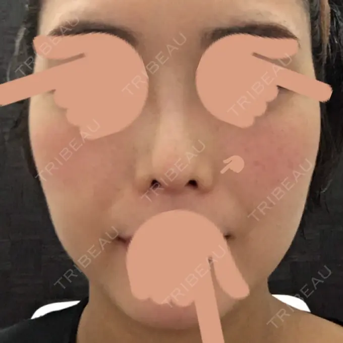 隆鼻術 / 鼻中隔延長（切開） / 斜鼻修正 / 真皮移植 / 鼻孔縁下降 加藤クリニック 麻布東京院 DAY 85 メイン用